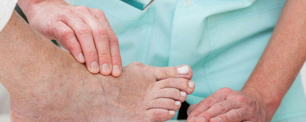 hallux valgus